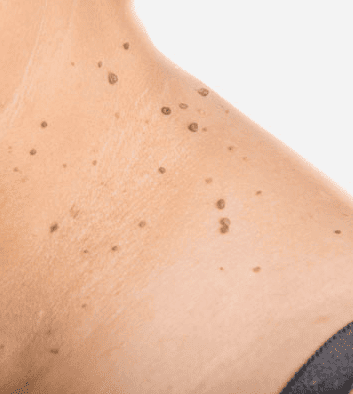 skin tags