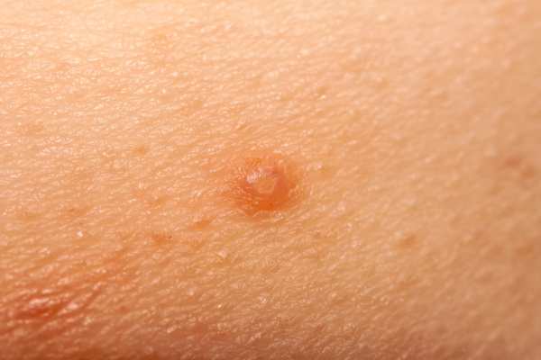 Molluscum Contagiosum Removal
