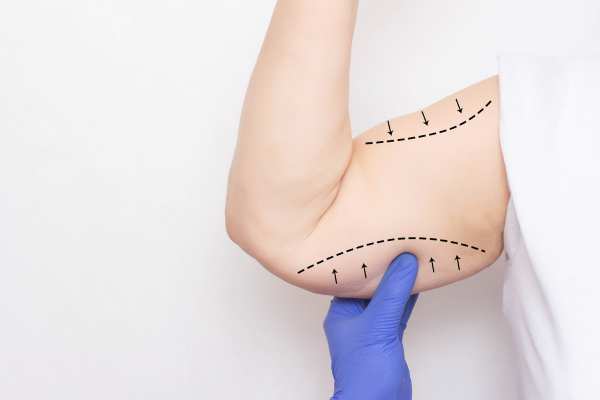 Arm toning treatment Broxburn from lipo Sculpt!