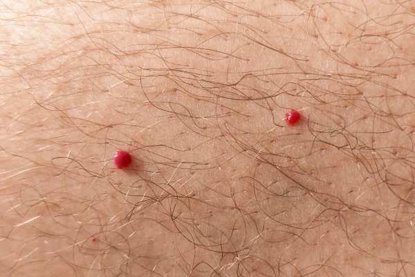cherry angioma removal