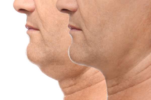 Book your Chin Reduction Treatment Broxburn today!