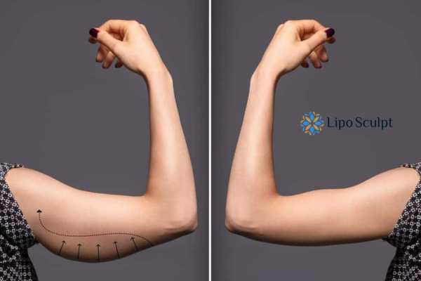 HIFU to reduce and tone sagging skin and fat on the arms from Lipo Sculpt Broxburn
