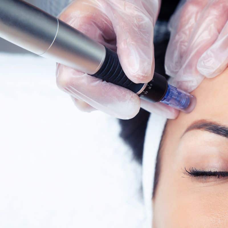Morpheus8 treatment Broxburn from Lipo Sculpt - Book in today!