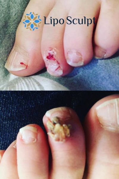 Wart removal customer results from Lipo Sculpt Broxburn