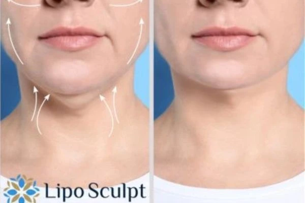 Book your Chin Reduction Treatment Broxburn today! Call Lipo Sculpt NOW!
