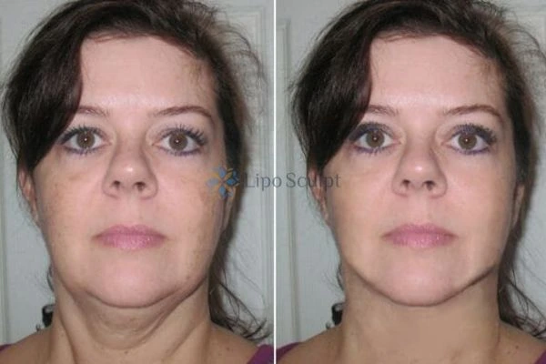 Chin Reduction Treatment Broxburn - Aqualyx treatment