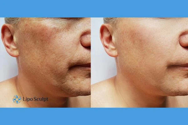 Get your Morpheus8 treatment Broxburn booked in today!