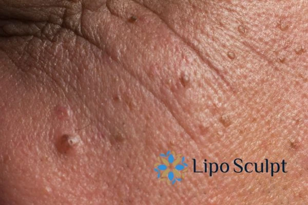 Remove skin lesions in as little as one treatment for an anti ageing Broxburn effect!
