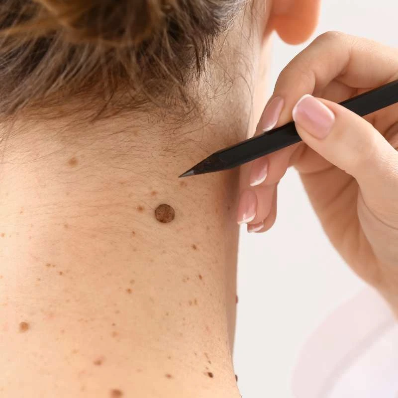 See our lesion removal prices Broxburn - call today for a free quote