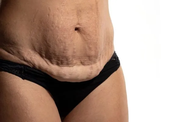 image of womans stomach after weight loss showing loose skin Broxburn 