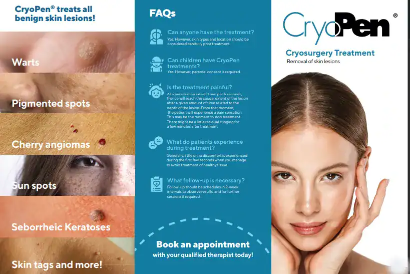 Benefits of Cryopen for seborrheic keratosis Removal Treatment Broxburn